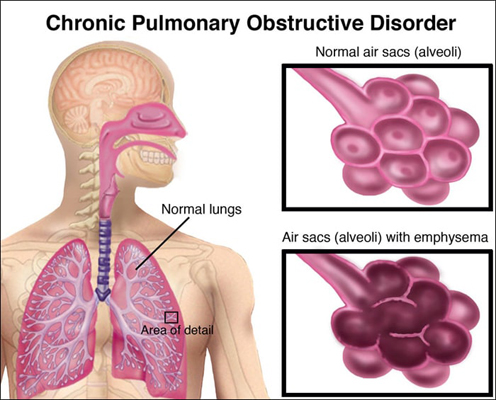 Chronic Obstructive Pulmonary Disease