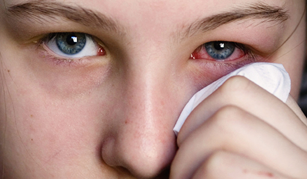 ophthalmia.
inflammation.
ophthalmitis.
redness.
pinkeye.