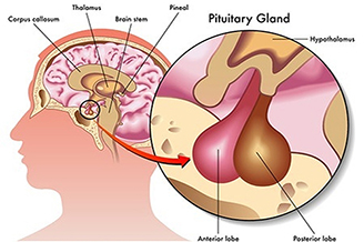 Hypopituitarism