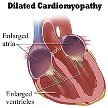 dilated-cardiomyopathy