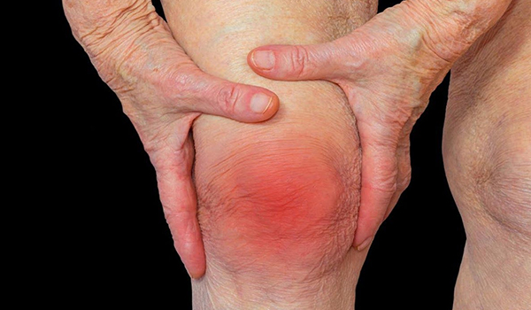 osteoarthritis,
gout,
inflammatory disease,
degenerative arthritis,
atrophic arthritis,