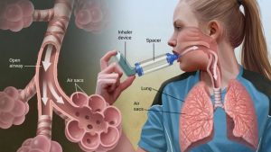 Ayurvedic Treatment of Bronchial Asthma