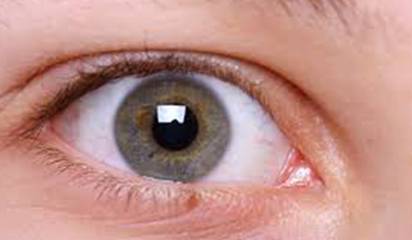 chronic glaucoma,normal tension glaucoma ,acute glaucoma, angle-closure glaucoma