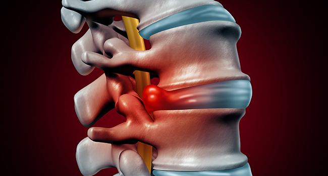 herniated disc,slipped disc,bulge disc,protruding disc,