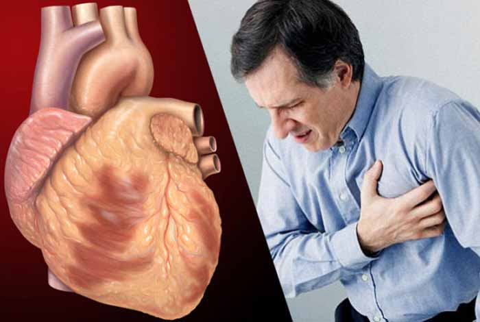 Coronary artery disease