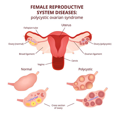pcos female problem