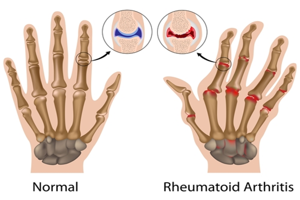 Arthritis 