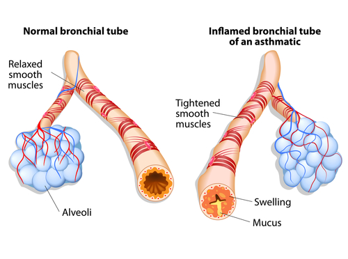 Introduction to asthma