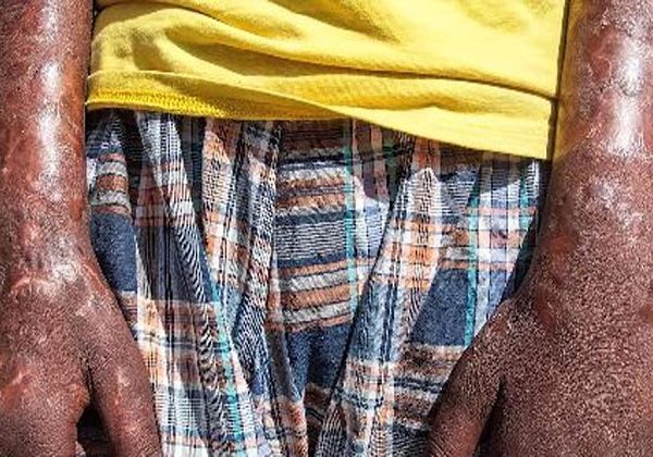 How To Treat Leprosy Naturally