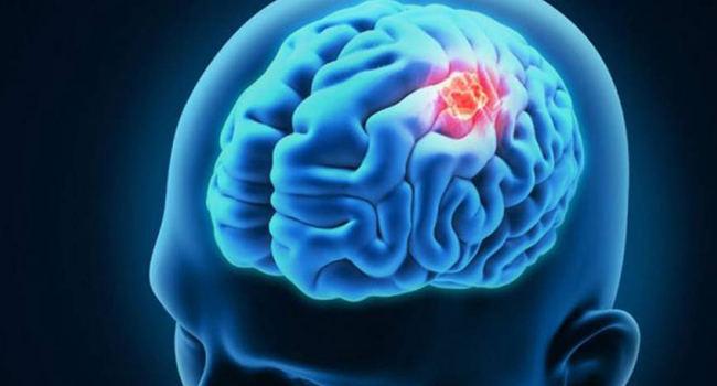 hydrocephaly,
abnormalcy,
abnormality,normal-pressure hydrocephalus