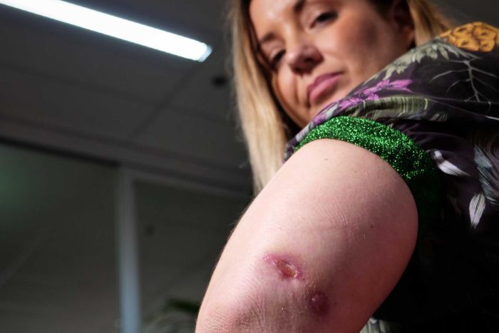 Natural treatment for Buruli Ulcer