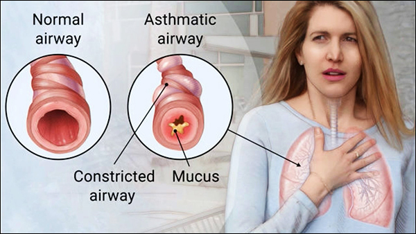 asthma, asthma causes, asthma symptoms, asthma treatment, ayurvedic treatment for asthma