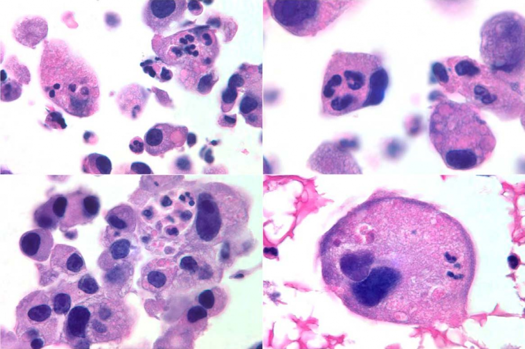 causes of hemophagocytic lymphohistiocytosis