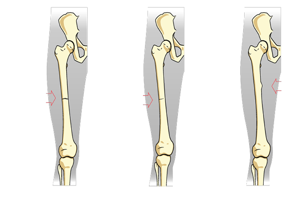 How Fractures Can Be Healed By Herbal Remedies