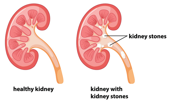 Ayurvedic Treatment for Kidney Stone with Home Remedies