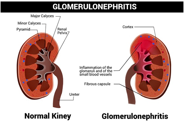 Natural Remedies For Glomerulonephritis