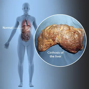 What is the Best Diet for People With Liver Cirrhosis? 