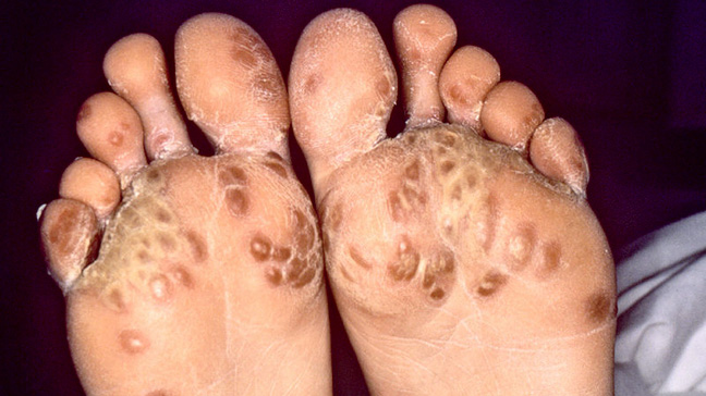 symptoms of Reactive Arthritis