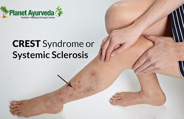 Systemic Scleroderma - A Rare Auto-Immune Disease!