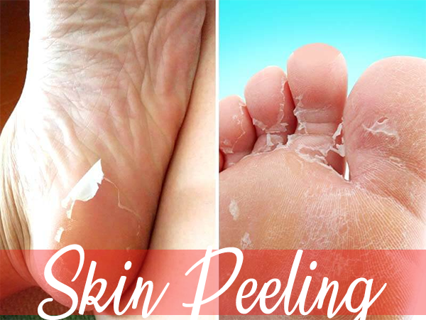 What Can Be The Causes Of Skin Peeling On The Hands